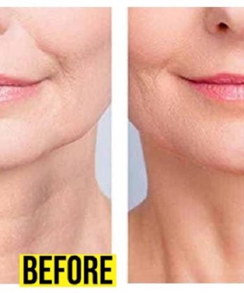 Before_After_for Woman Neck